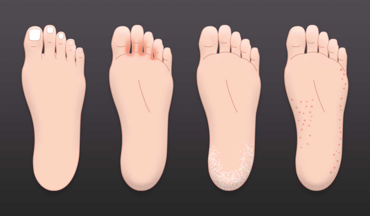 Different clinical forms of Athlete's Foot