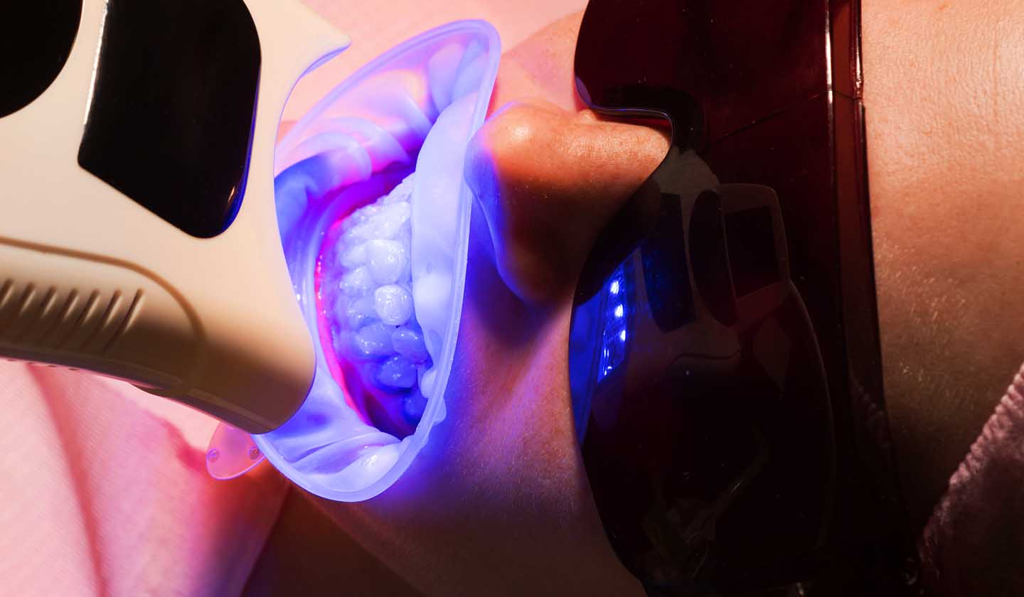 Teeth whitening - materials and techniques