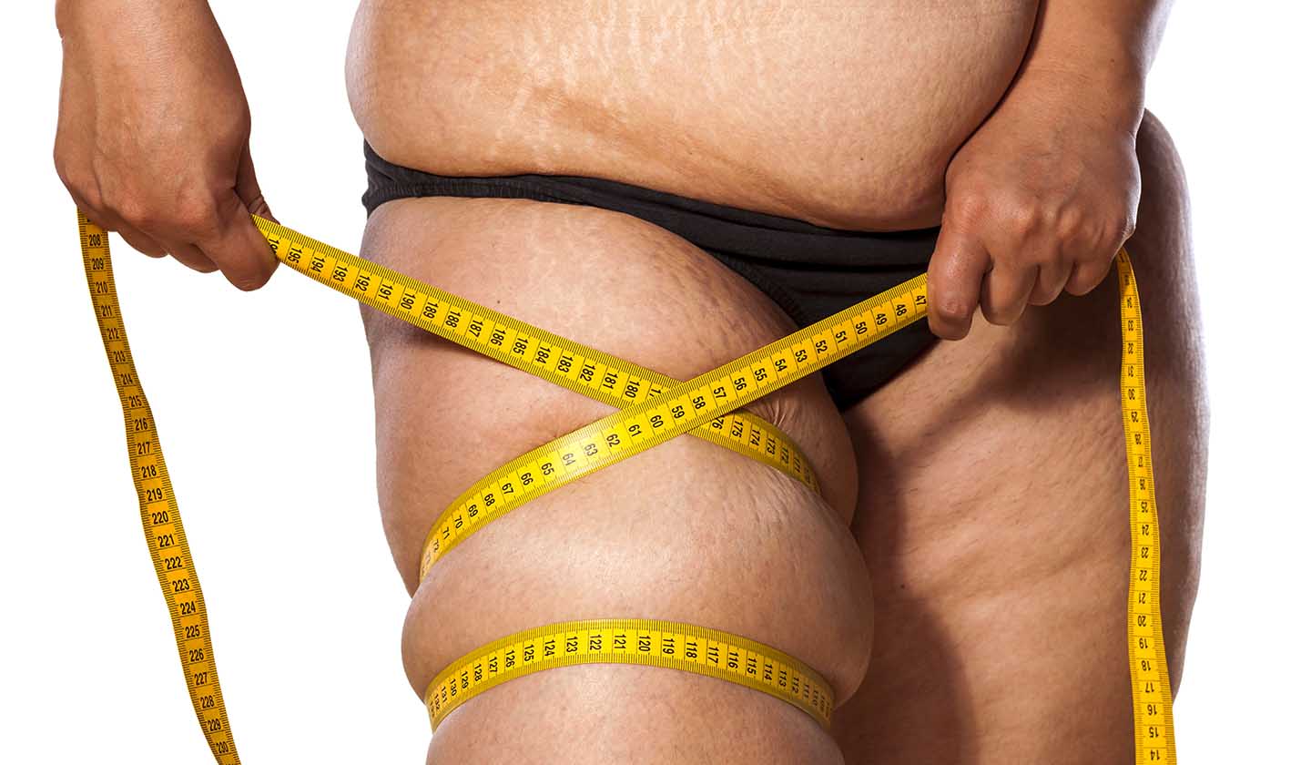 Cellulite is a matter of fat