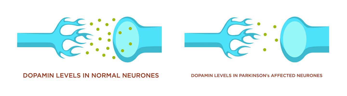 Decreased dopamine levels in Parkinson's disease