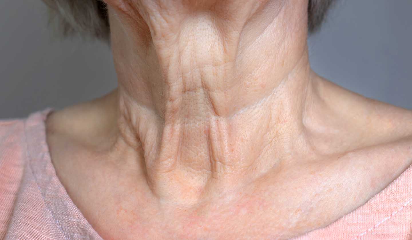 Flaccid neck