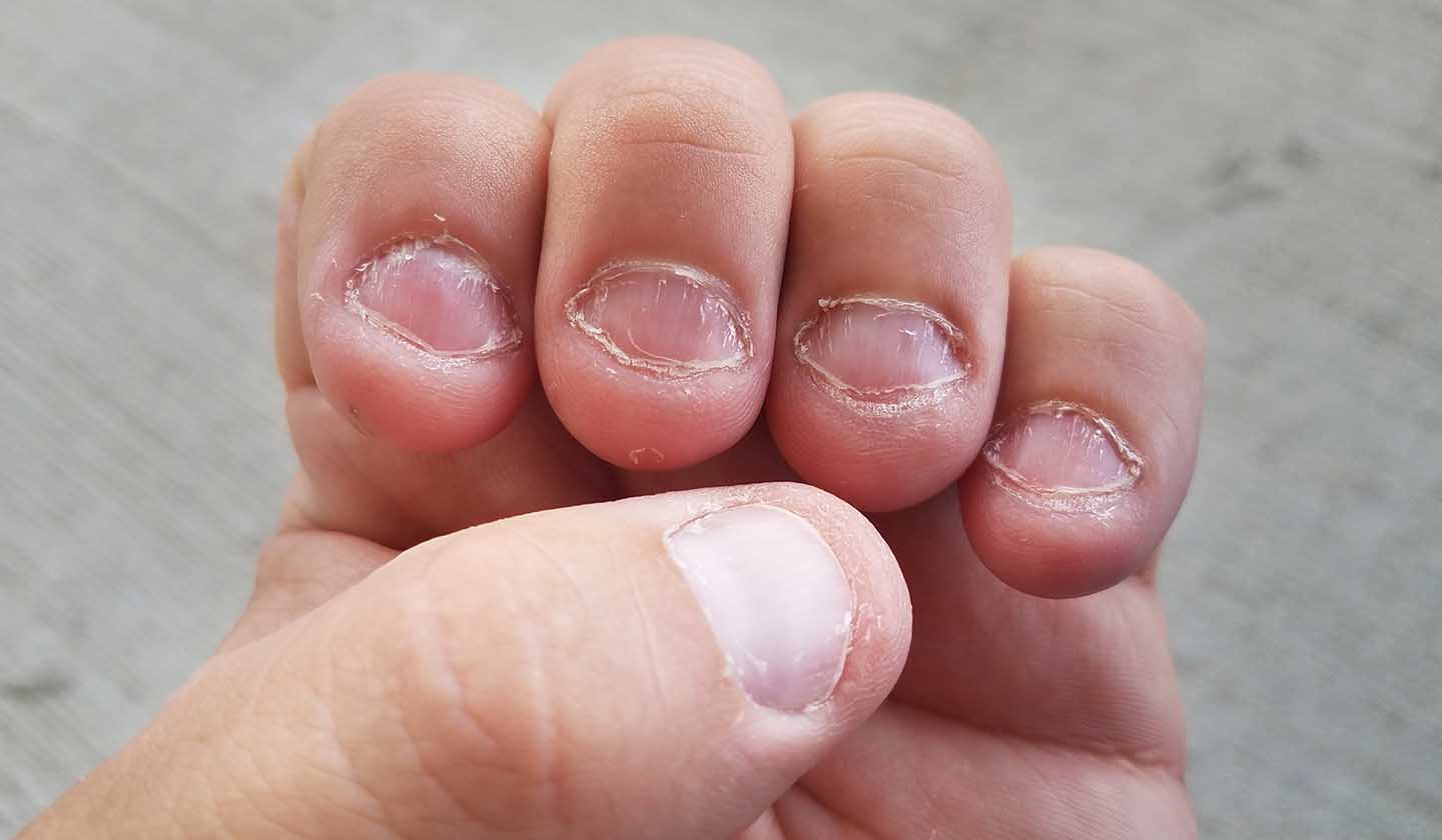 Biting your nails could ruin your teeth, here's why! | The Times of India