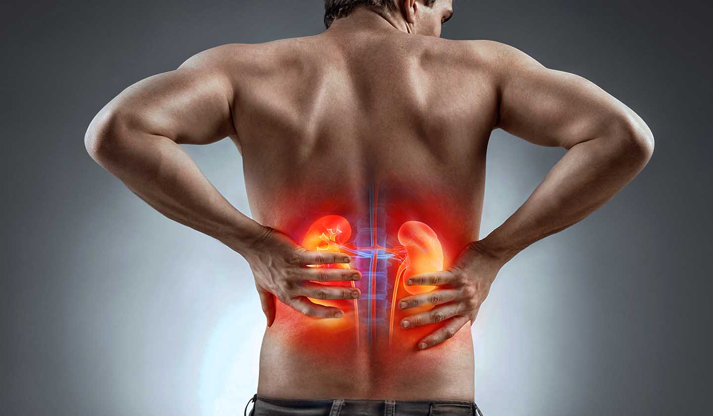 Kidney Stones - Warning signs