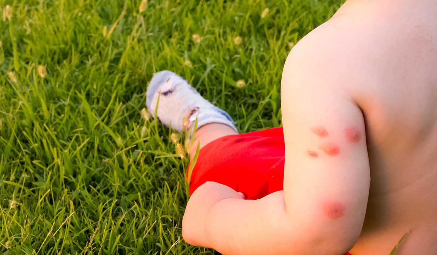 Insect bites - Symptoms 