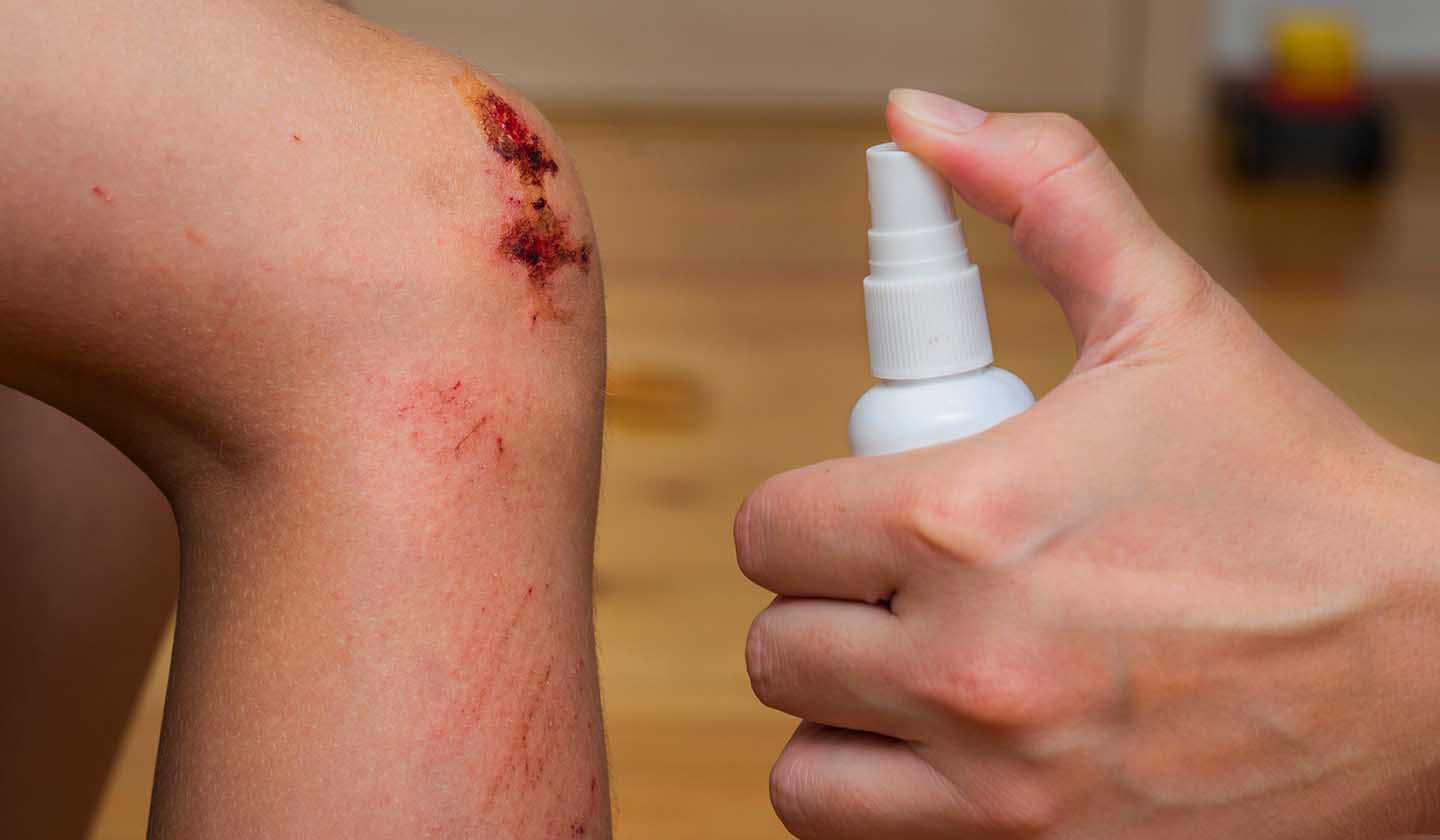 How to treat a wound