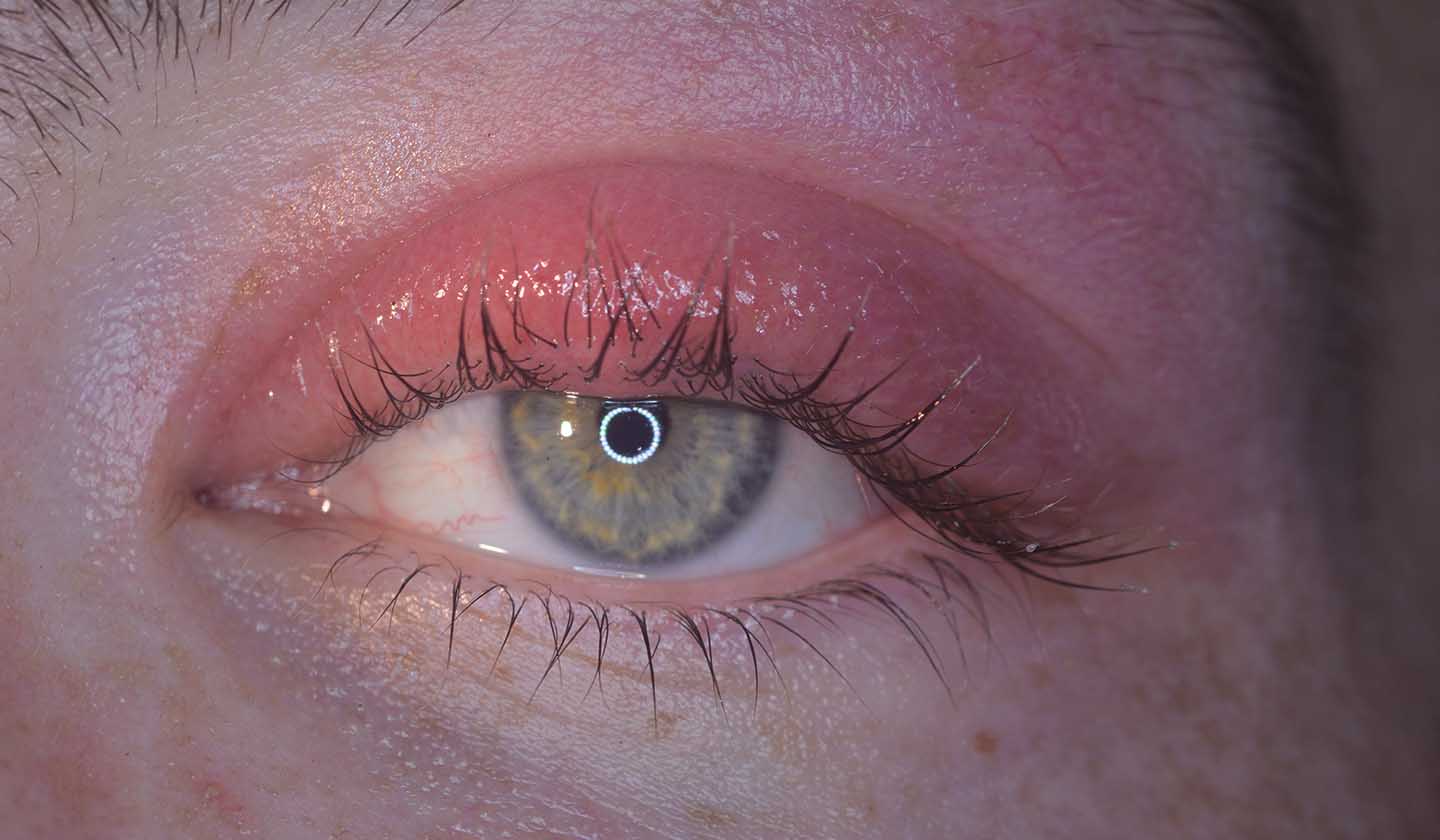 Blepharitis 