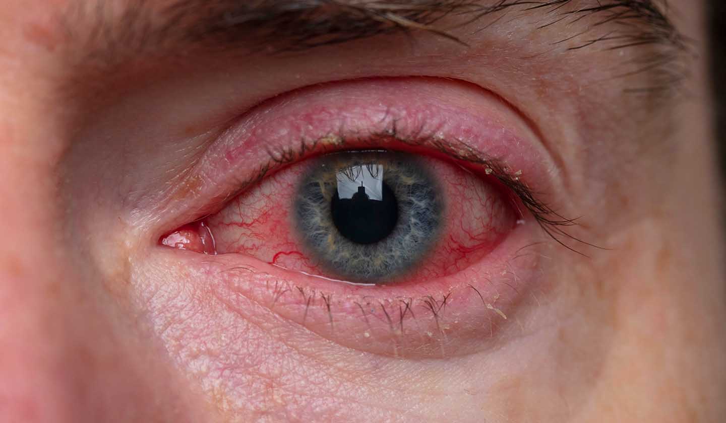 Olhos vermelhos