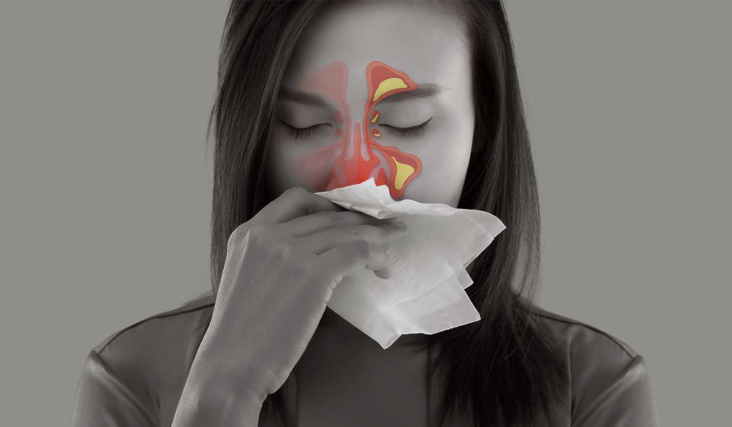 Sinusitis - Symptoms