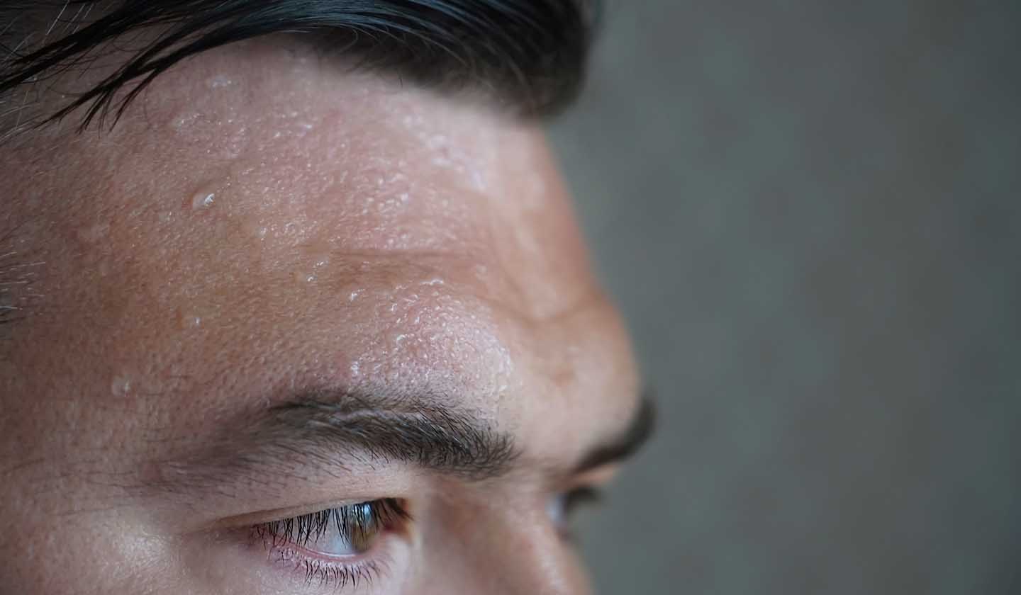Types of Excessive sweating
