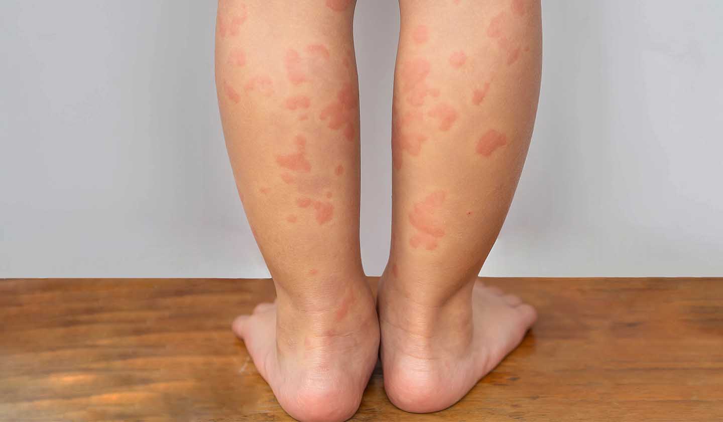 Urticaria - Clinical manifestations