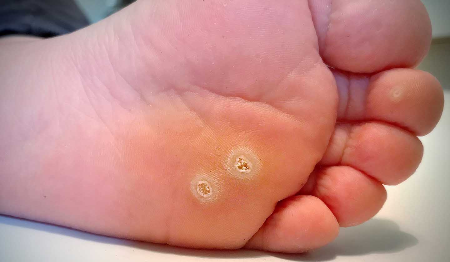 Plantar warts - Causes