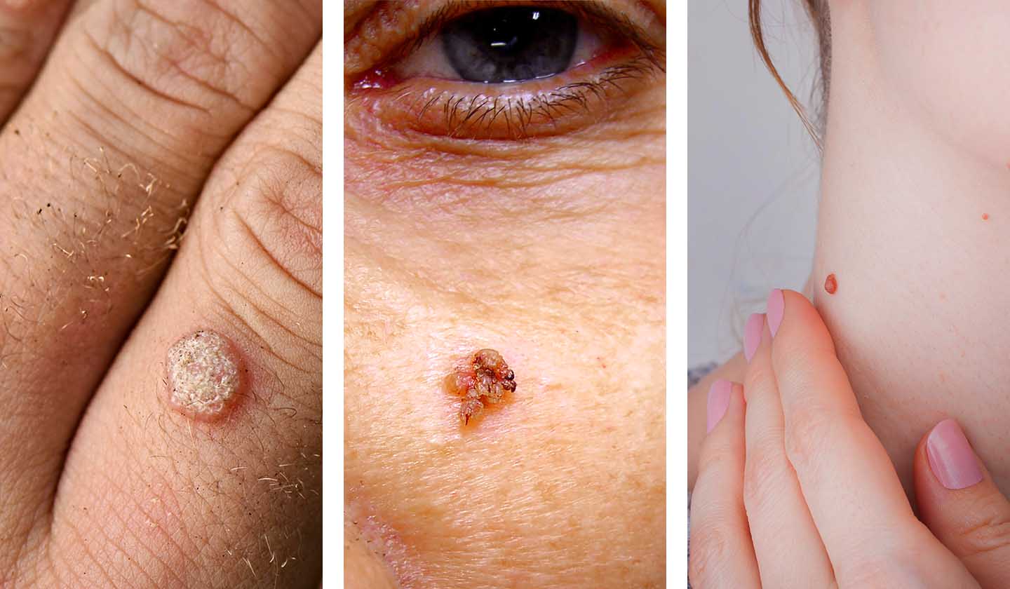 Types of warts