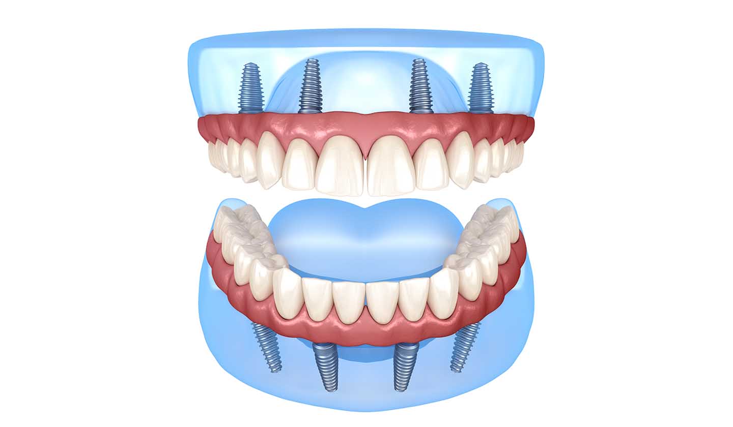 Fixed prostheses