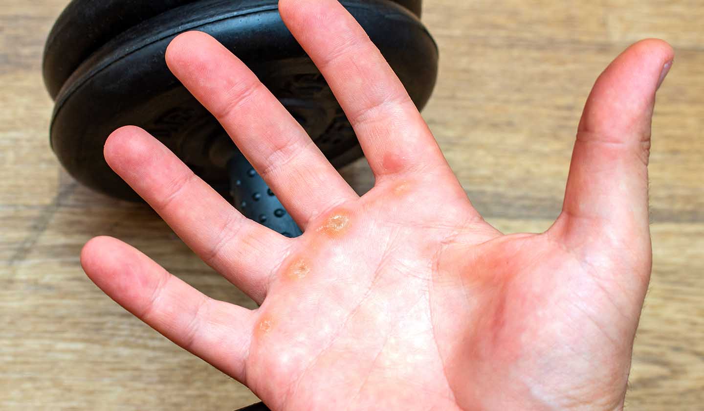 Calluses on the hands