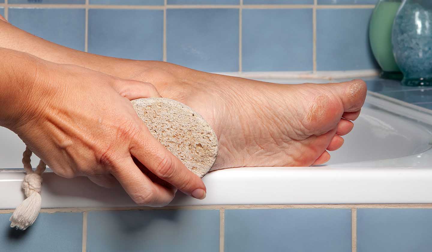 Preventing calluses