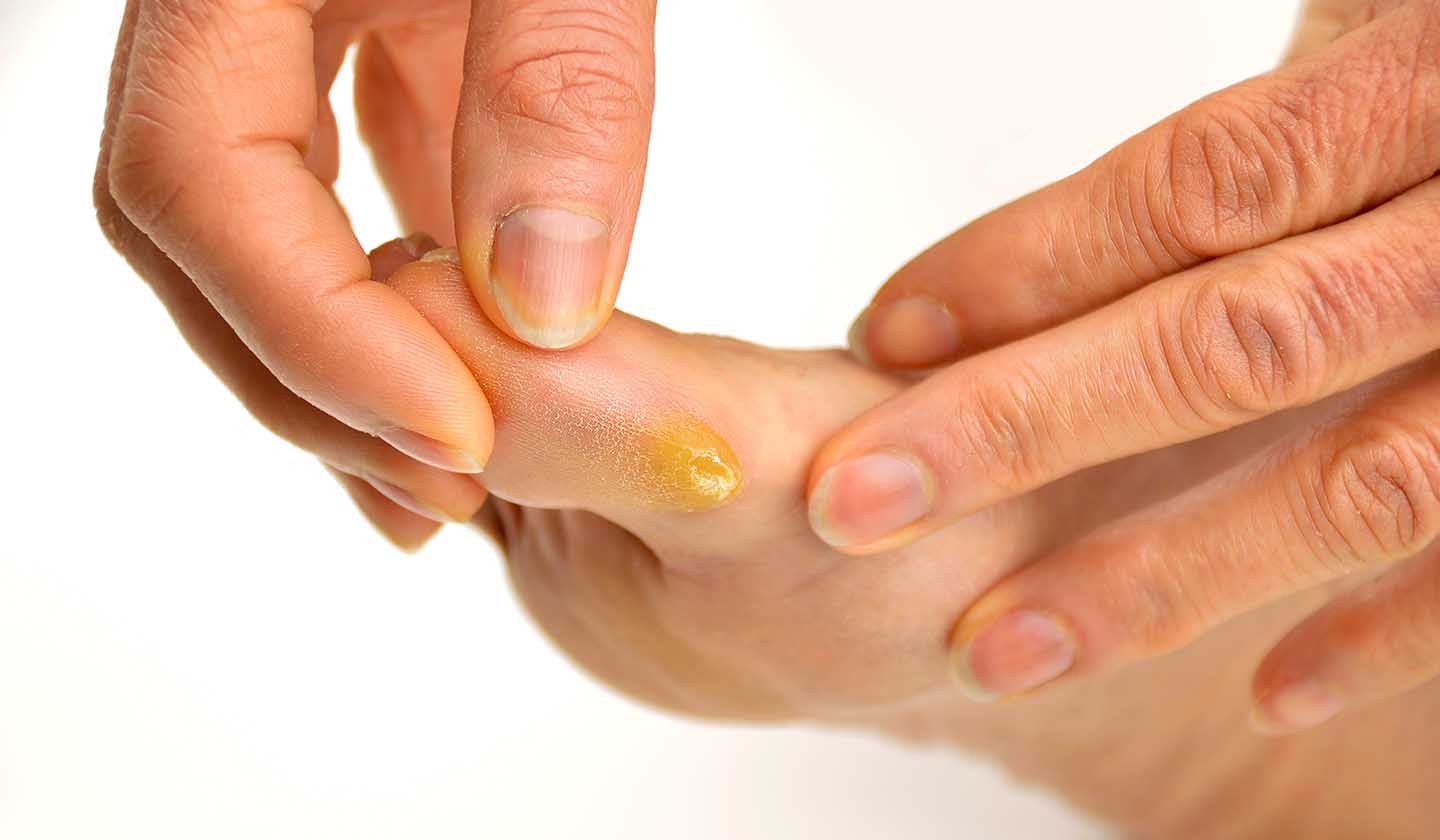 Calluses on the feet