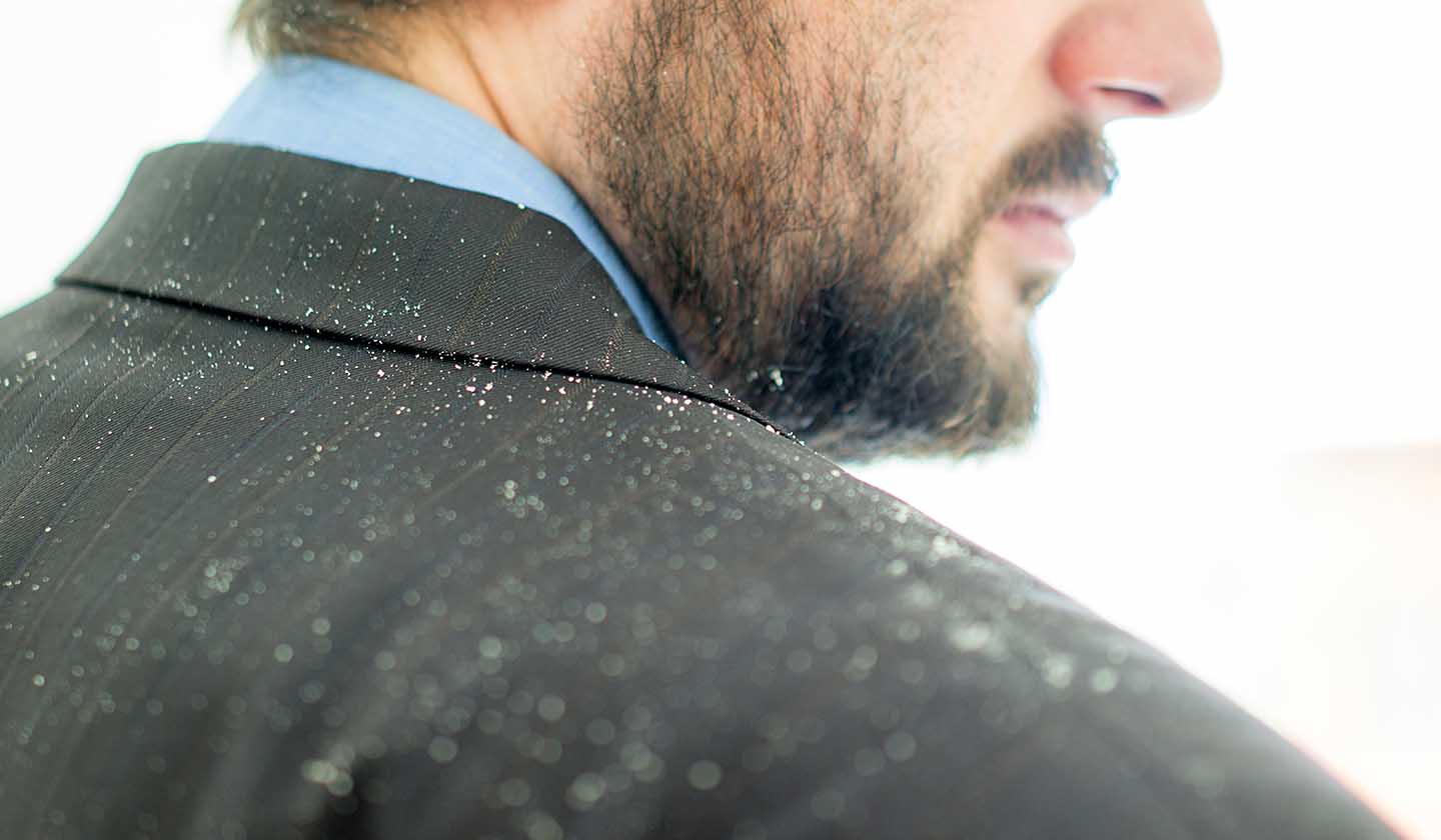 Dandruff is more frequent in men