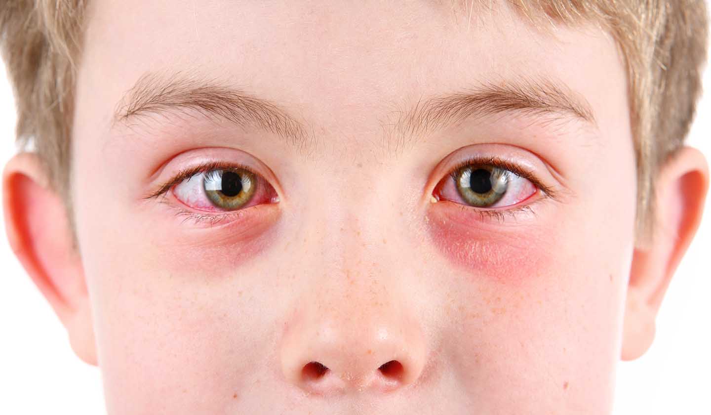 Conjuntivite alérgica perene afeta os dois olhos