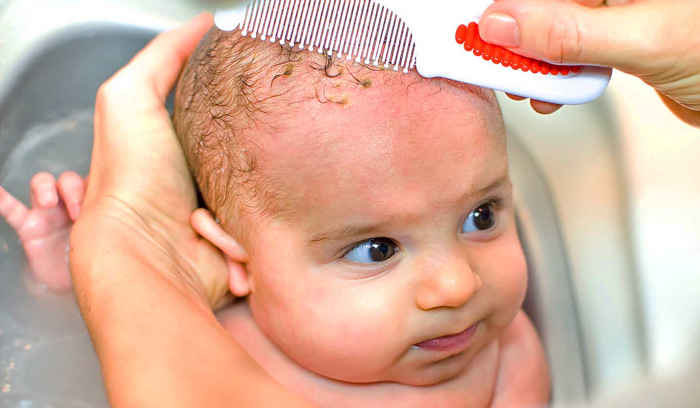 Specific products to treat the cradle cap