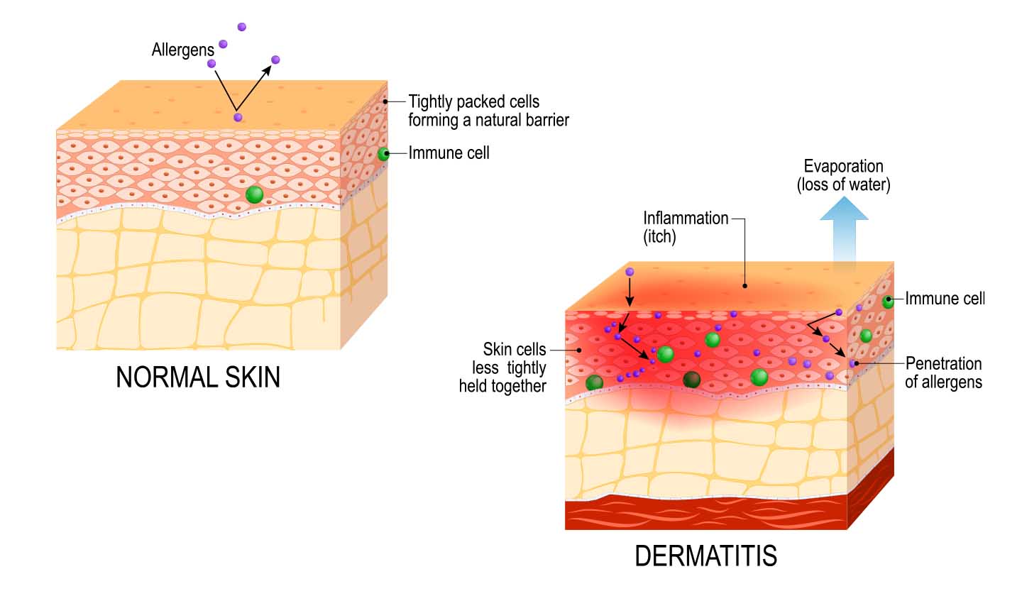 Normal skin and atopic skin