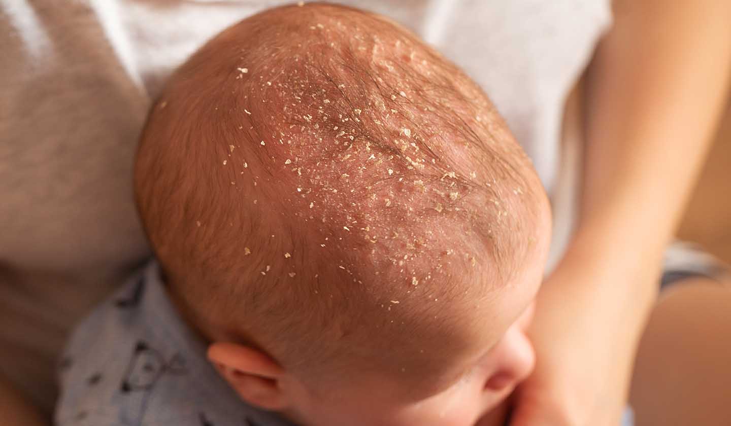 Dermatite seborreica no couro cabeludo do bebé