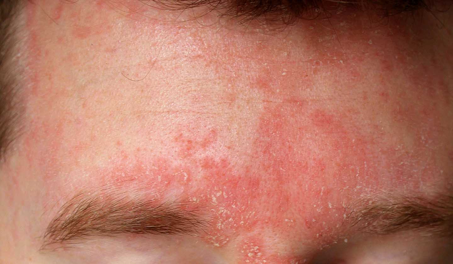 Face affected by seborrheic dermatitis