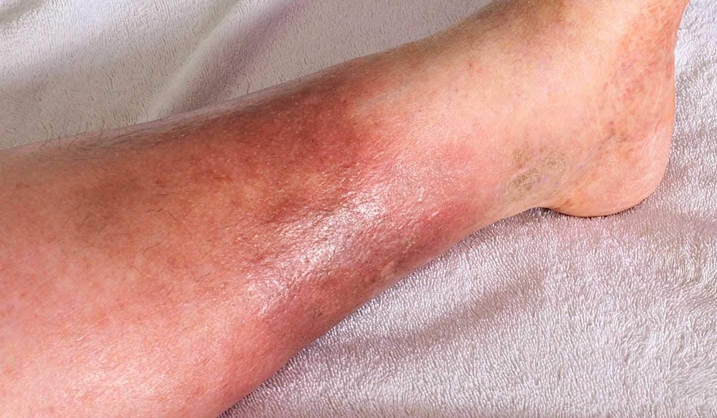 Advanced state of chronic venous insufficiency