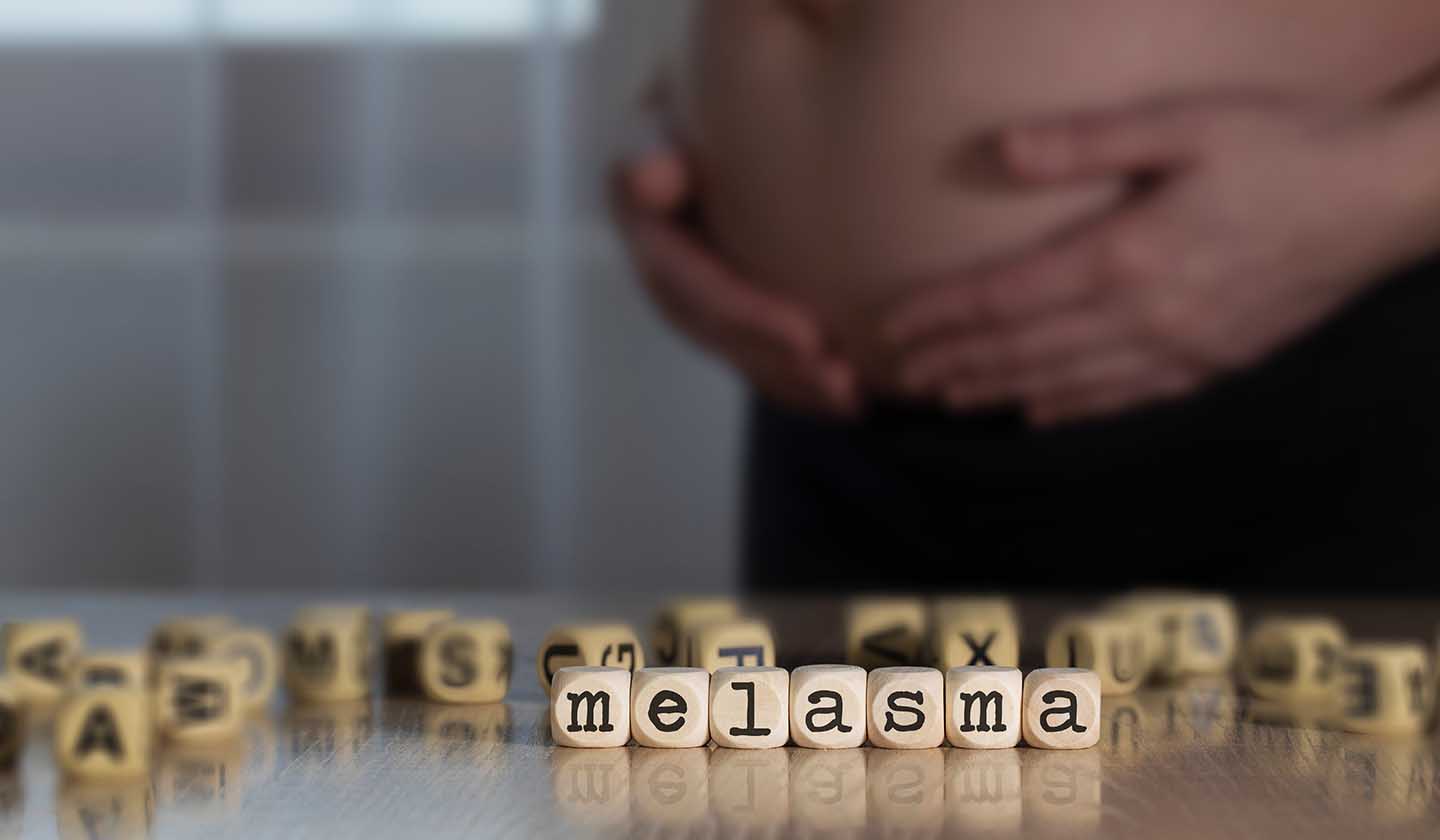 Melasma (“pregnancy mask”) during pregnancy