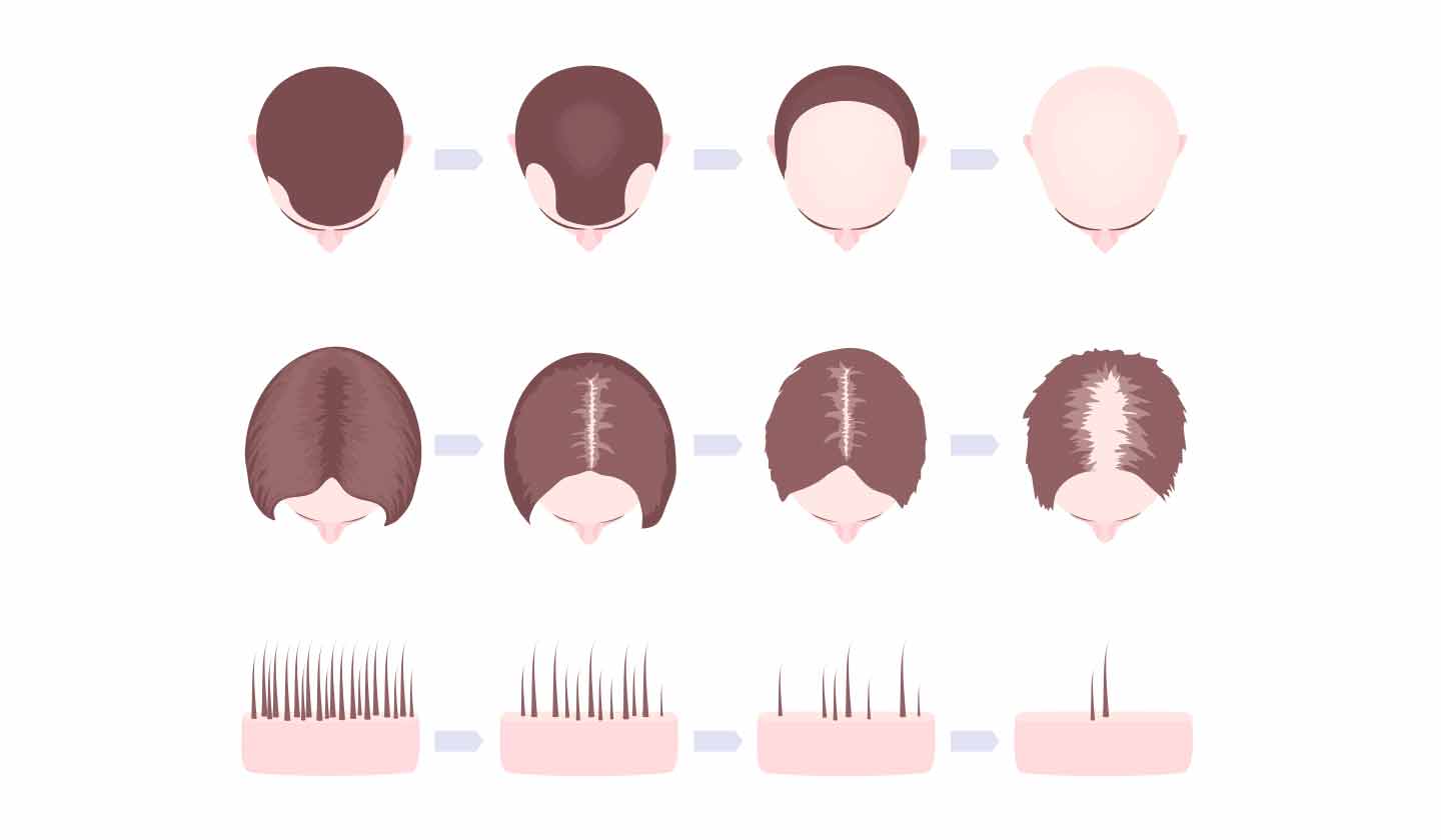 Evolução da queda de cabelo