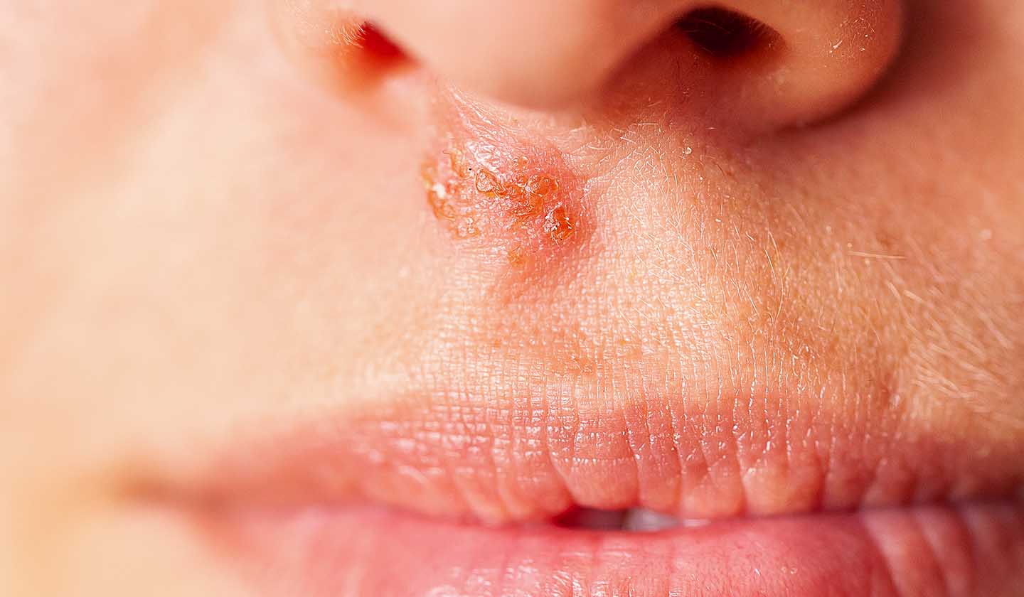 Cold sores in the area below the nose