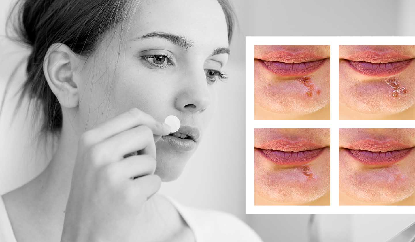 Labial patches - Evolution and treatment of cold sores