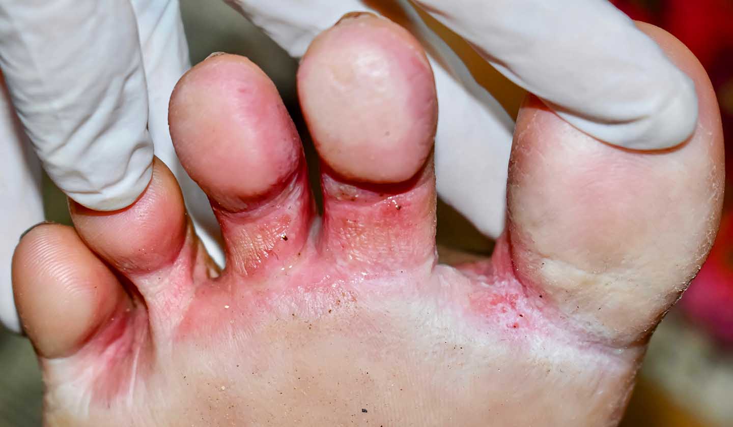 Mycoses between toes or athlete's foot