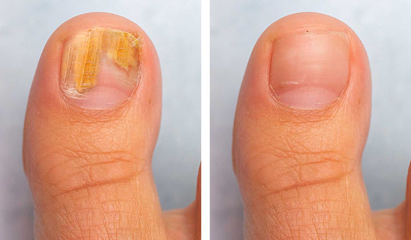 Onychomycosis, nail infection