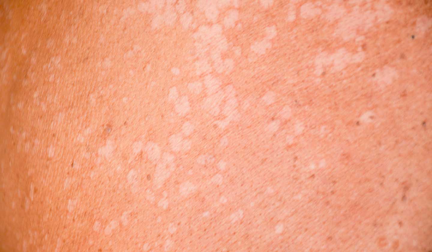 Pityriasis versicolor or white cloth