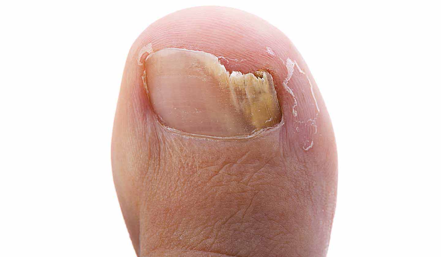 Toenail getting brittle