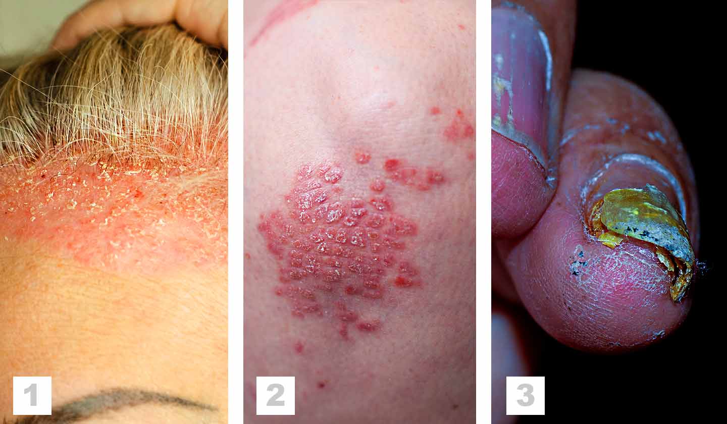 Psoriasis - forms