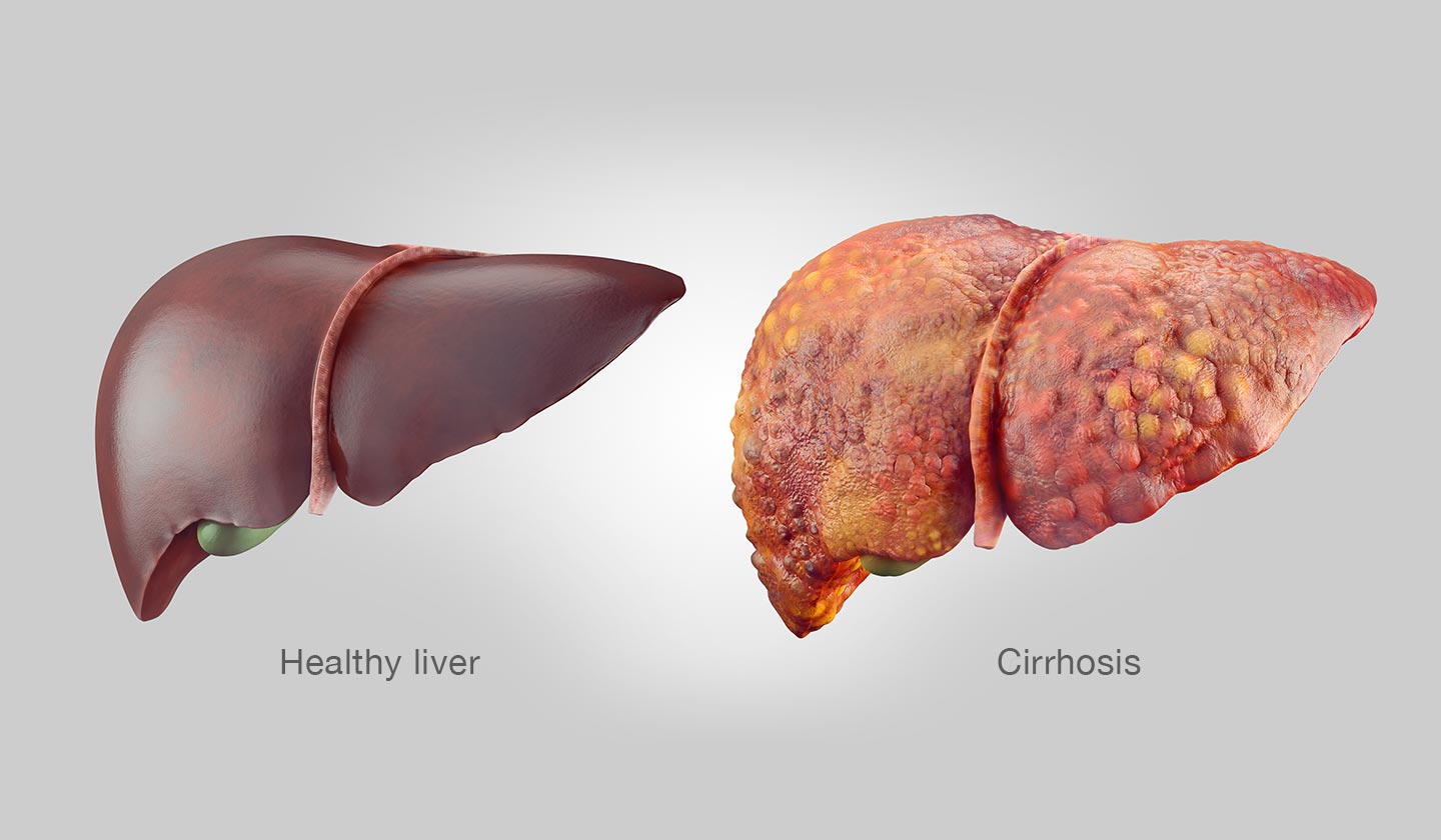 Liver complications among others