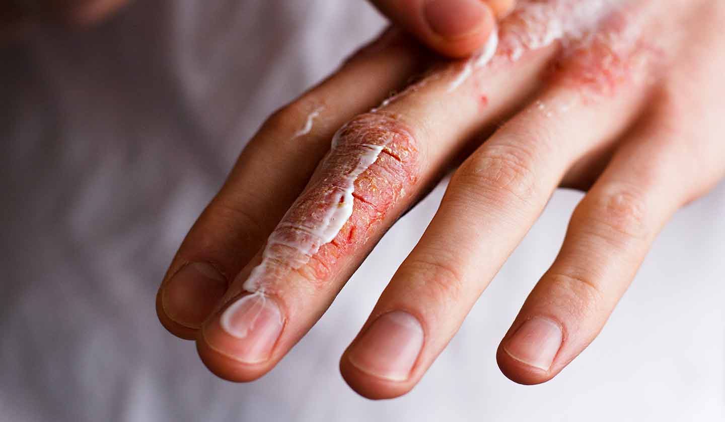 Fissures - a characteristic of dry skin