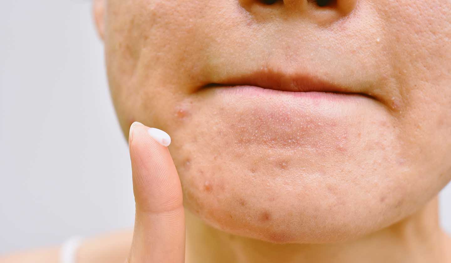 Tratamento da acne