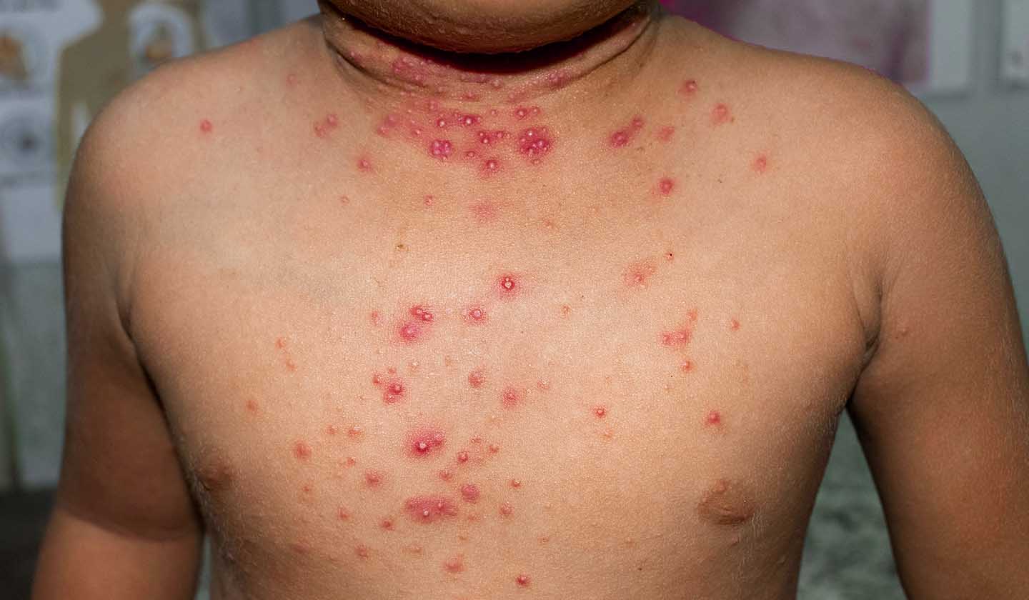 Molluscum Contagiosum - Transmission