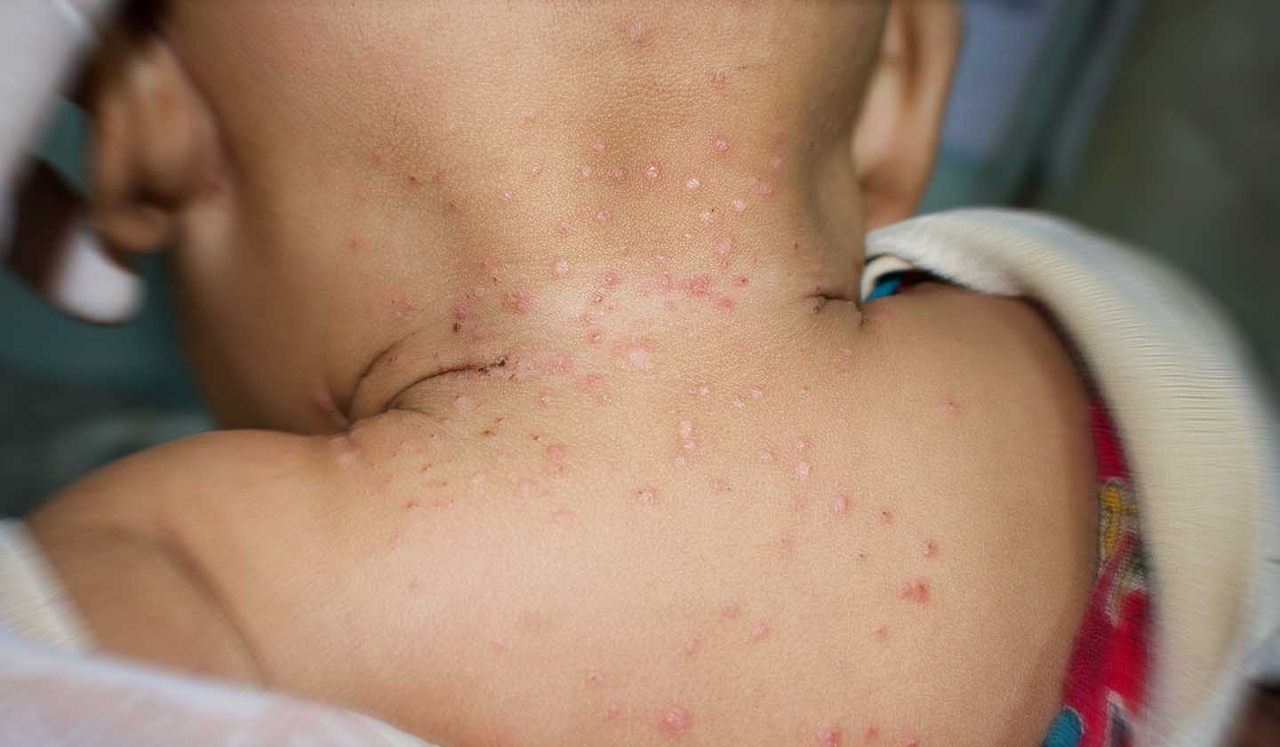 Molluscum Contagiosum - Signs and symptoms