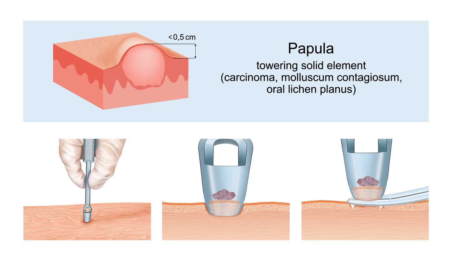 Molluscum Contagiosum - Treatment