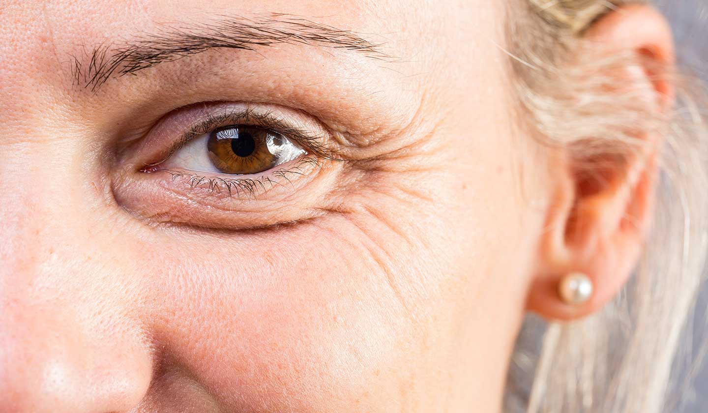 Dark circles, a sign of aging