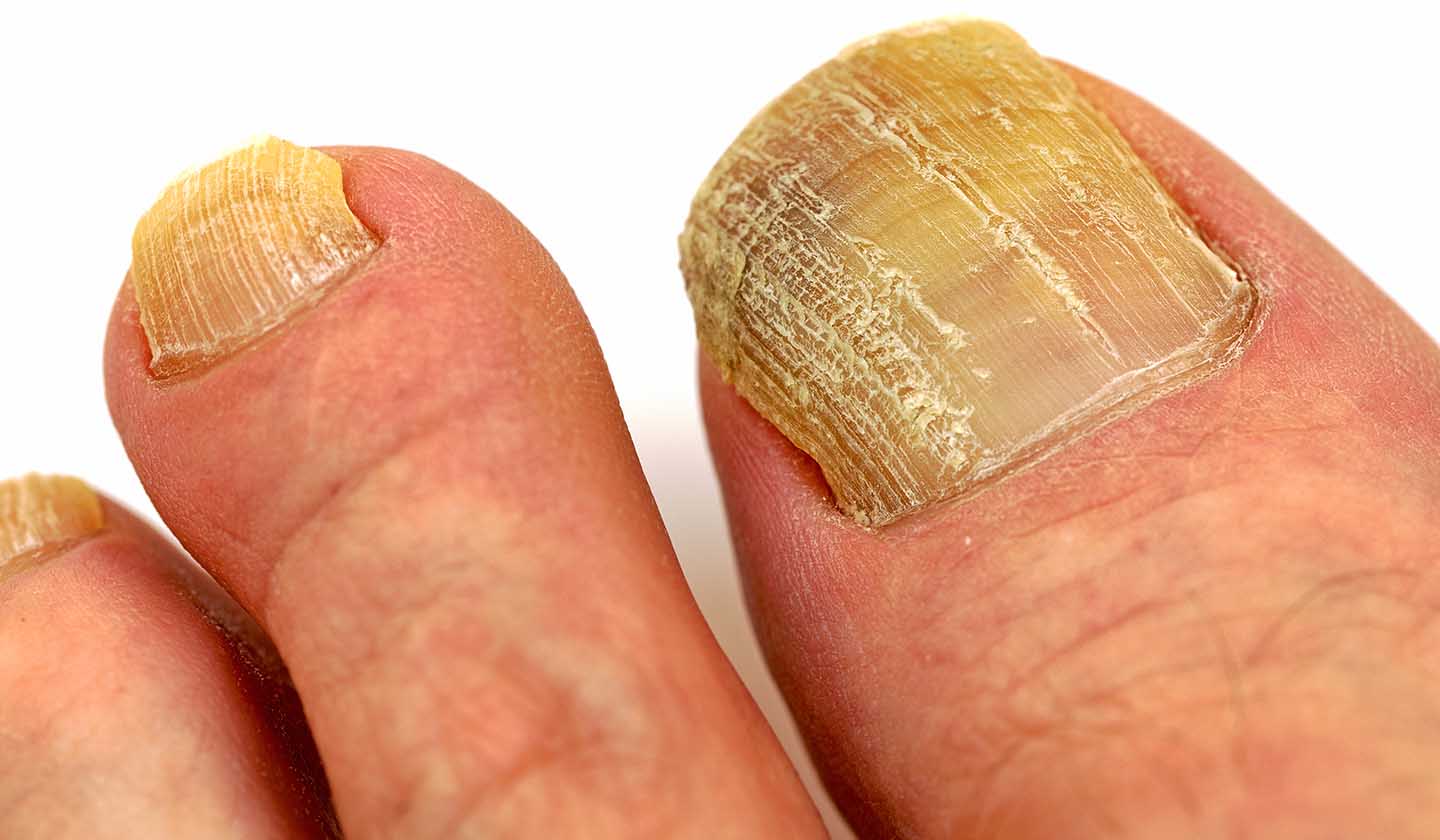 Disseminação de onicomicose nas unhas dos pés