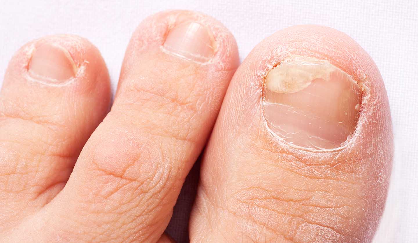 Understandign Toenail Fungus in Manhattan & Whitestone, NY