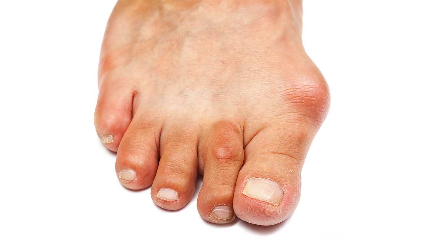 Osteoarthritis in the foot