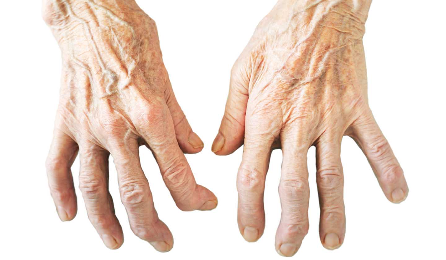 Hands with deformed joints