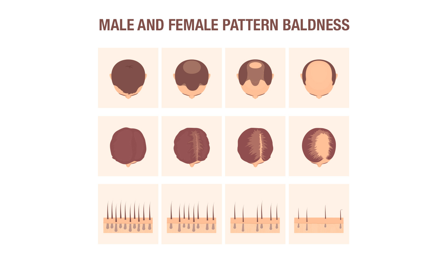 Male and female pattern baldness