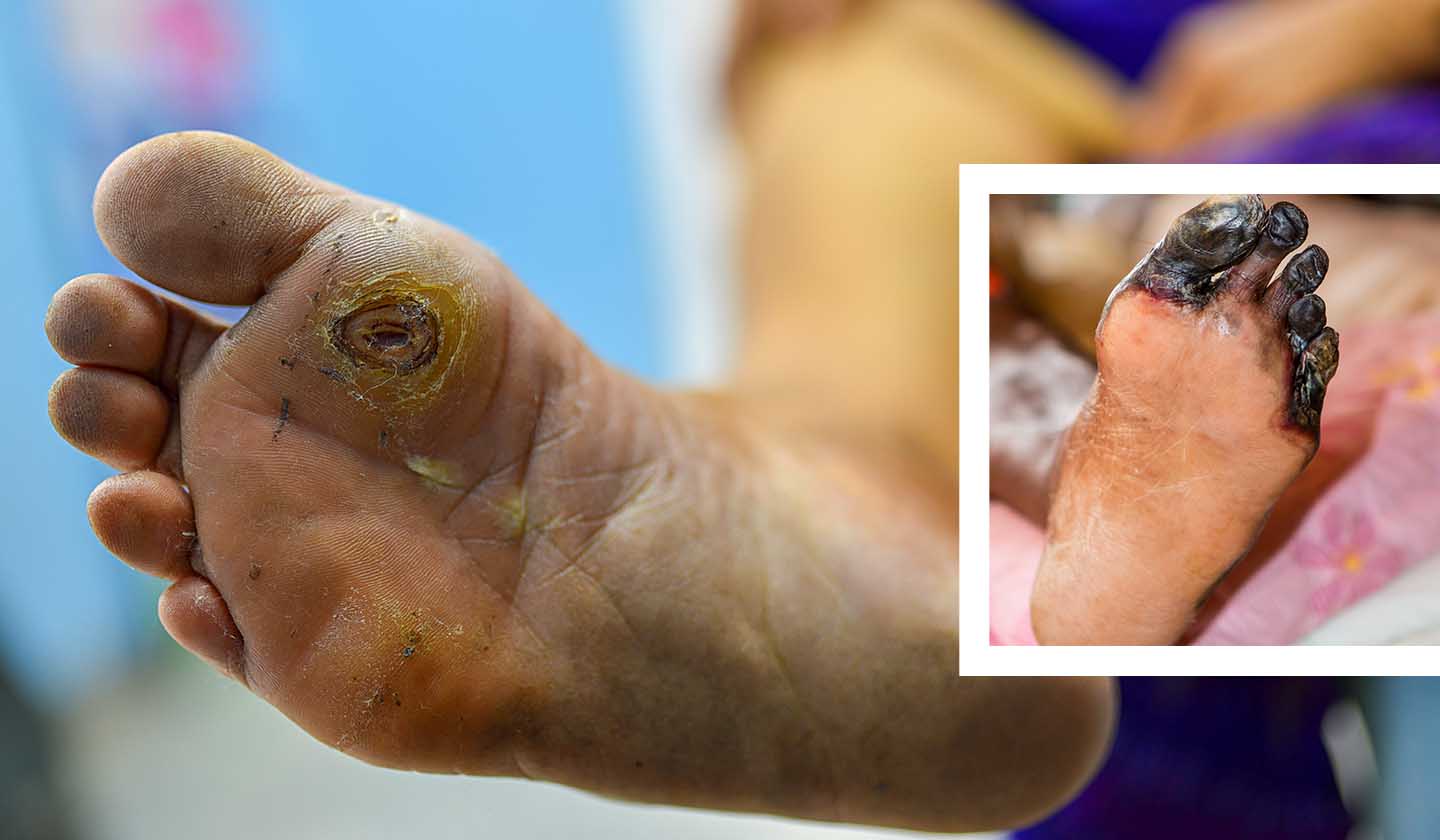 Changes that may indicate Diabetic Foot and toe gangrene