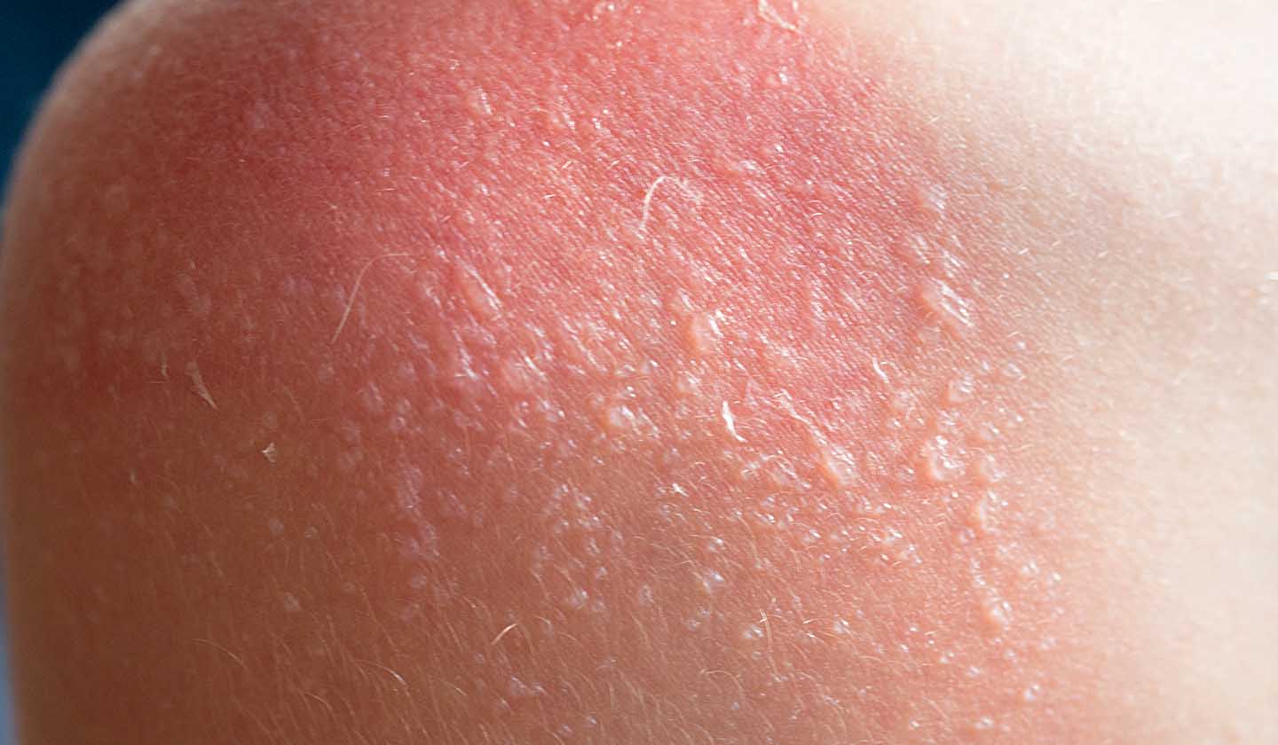 Queimadura solar grave com bolhas na pele